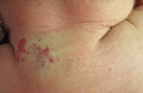 海绵状血管瘤是像海绵样的吗,海绵状血管瘤怎么形成的