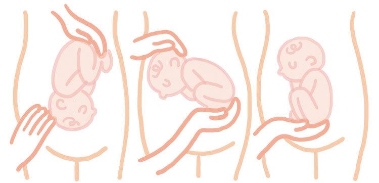 胎位不正艾灸纠正的最佳时间,胎位不正用艾灸纠正方法视频