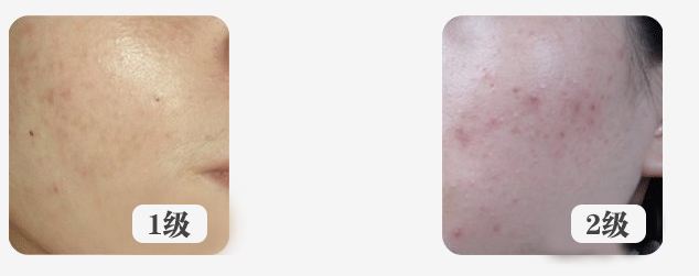 面部痘痘认知,痘痘的认知