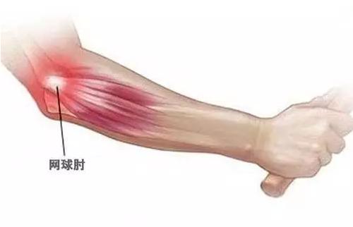 连谢霆锋都要发愁的“网球肘”是什么？有什么症状？