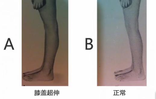 膝盖过伸如何矫正锻炼的图解,膝盖超伸怎么矫正腿型