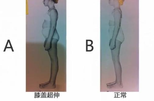 膝盖过伸如何矫正锻炼的图解,膝盖超伸怎么矫正腿型