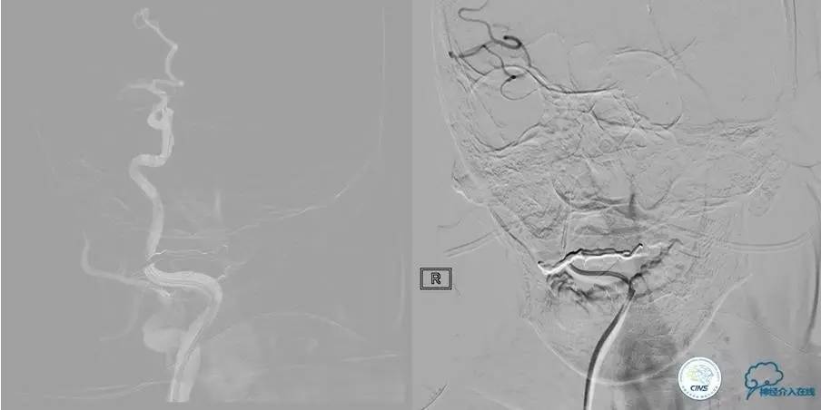 急性缺血性卒中静脉溶栓2018指南,急性缺血性卒中血管内再通标准