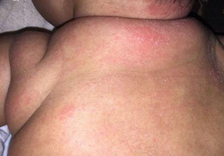 婴儿脸上疹子,婴儿疹子