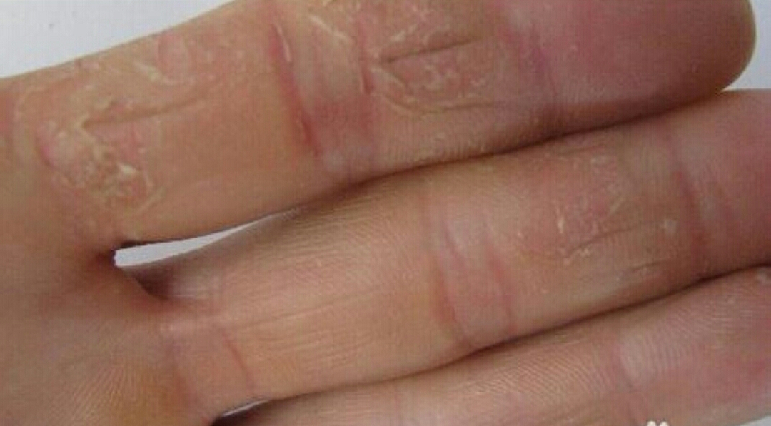 患有手足皲裂（裂口子）症的亲，最值得收藏哟