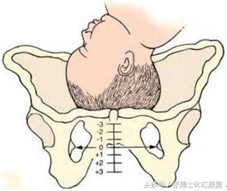 孕期怎么锻炼缓解耻骨疼痛,孕期耻骨疼怎么走路正确