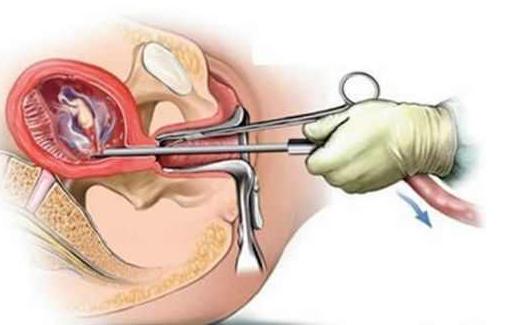 怀胎一两个月打掉孩子有副作用吗,四个多月打掉孩子做无痛会痛吗
