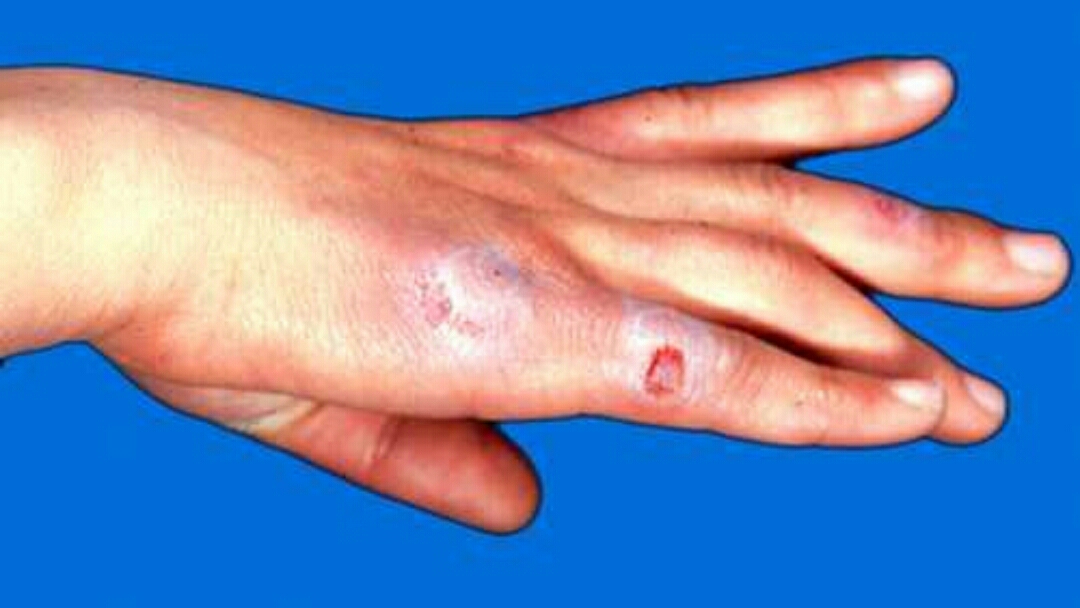 冻伤疮什么意思,冻疮的治疗方法