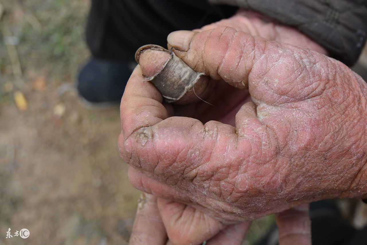手脚皮肤干裂怎样快速保湿,冬季嘴巴周围皮肤干裂涂什么有效