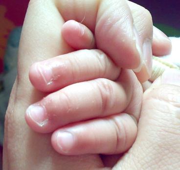 宝宝手起疹子皲裂,宝宝手长倒刺肿了怎么办