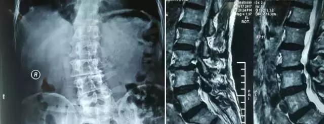 脊柱内镜辅助治疗脱垂游离型腰椎间盘突出1例