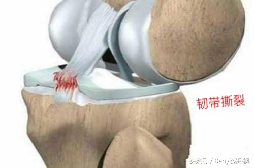 膝关节疼痛如何预防和干预,膝盖常见伤病症状