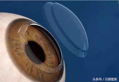 角膜塑形镜的设计与适应症ppt,角膜塑形镜的材质与工艺