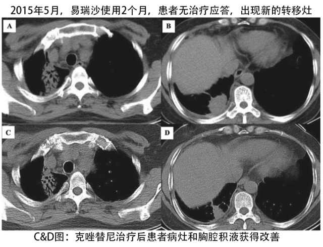alk阳性肺癌克唑替尼,肺腺癌met基因突变克唑替尼耐药