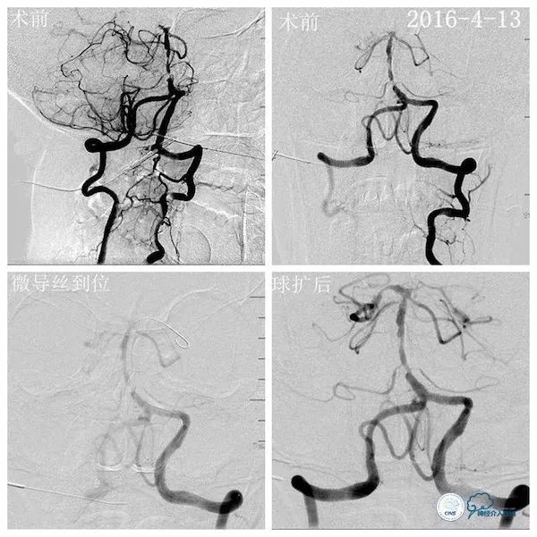 天坛医院脑血管狭窄手术做得好吗,天坛医院动脉狭窄介入手术费用