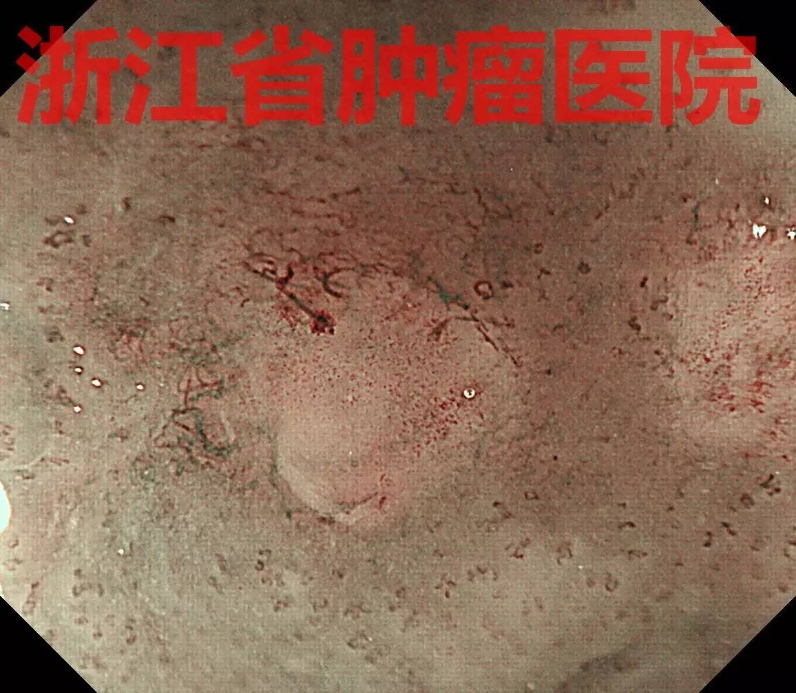 食管黏膜病变越大就一定是恶性吗,食管病变严重需要怎么治疗