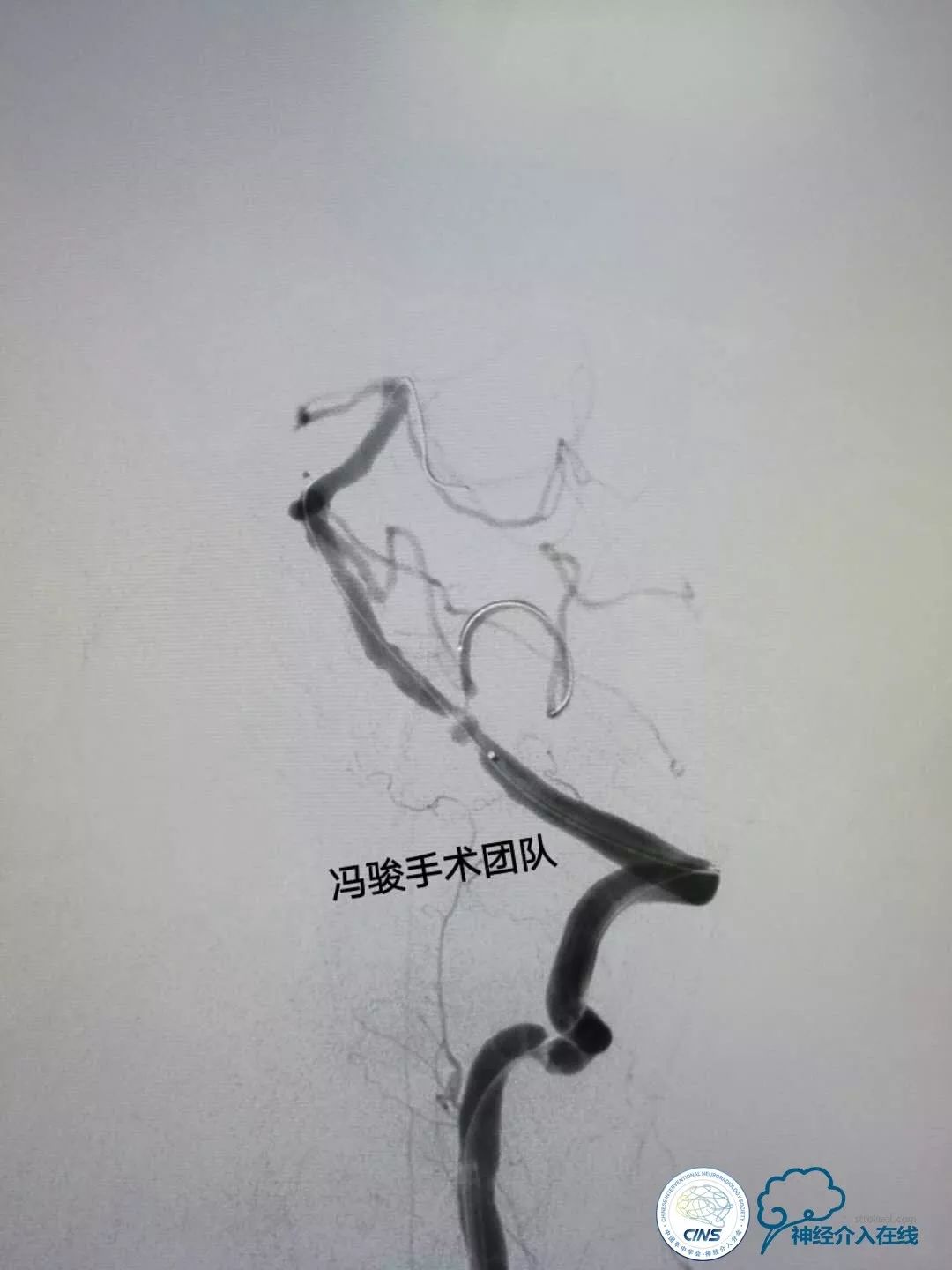 天新福—百家百言｜一例孤独椎动脉V4段并PICA重度狭窄支架手术及1年随访