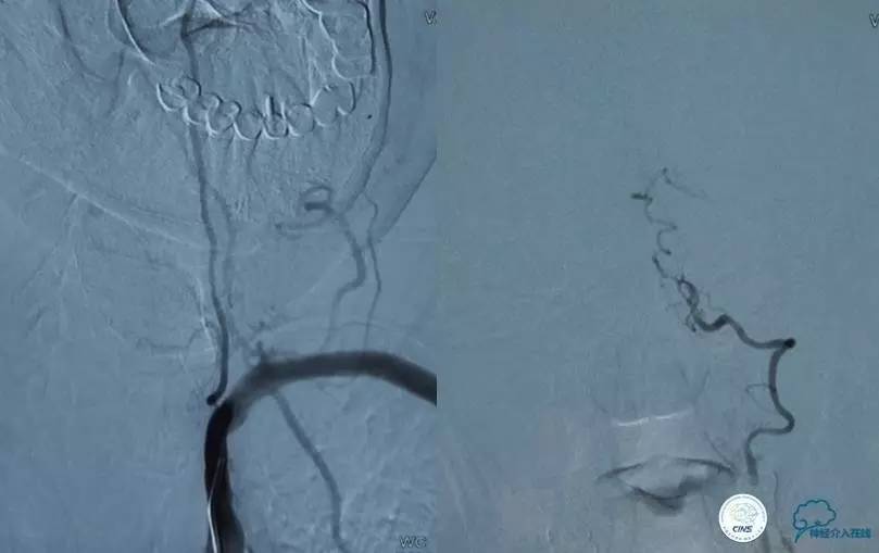 急性缺血性卒中静脉溶栓2018指南,急性缺血性卒中血管内再通标准
