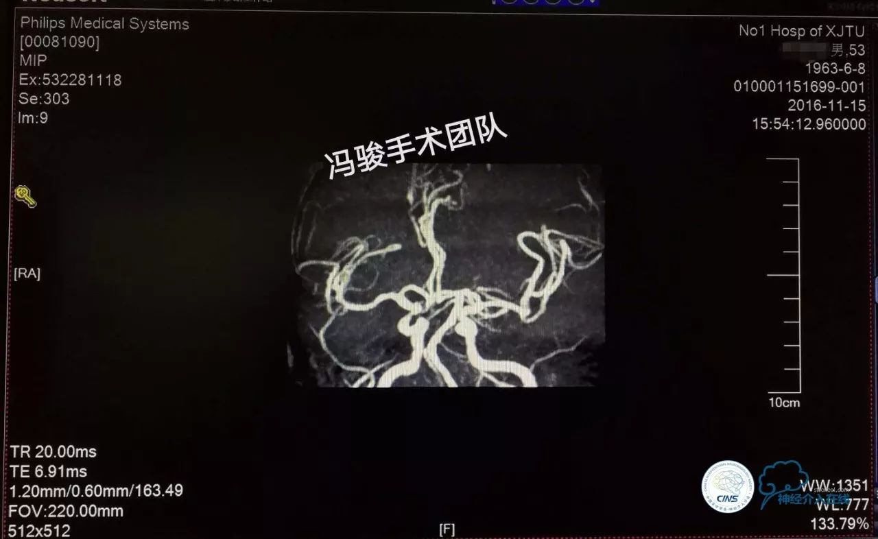 天新福—百家百言｜一例孤独椎动脉V4段并PICA重度狭窄支架手术及1年随访