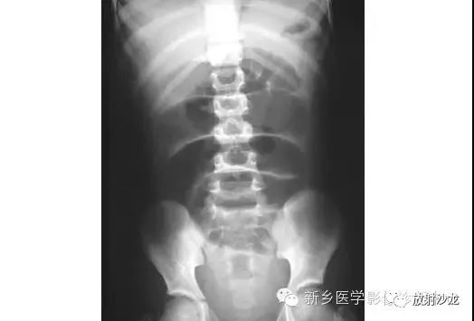 详细腹部平片解剖+正常表现+读片技巧+病例分析
