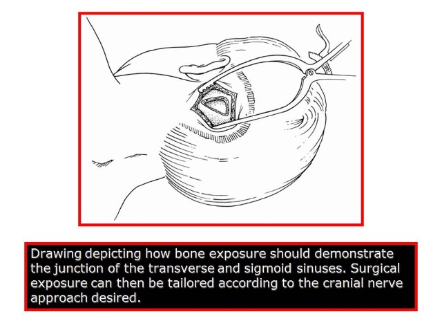 三叉神经痛和继发性的三叉神经痛,三叉神经贴治疗三叉神经痛的原理