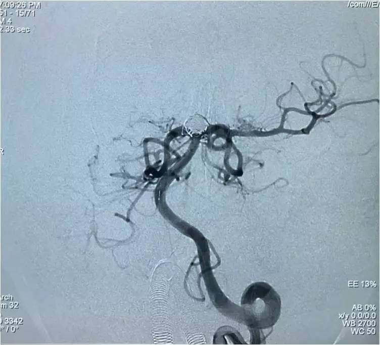 基底动脉顶端动脉瘤加左侧小脑上动脉瘤以Y型支架结合弹簧圈栓塞