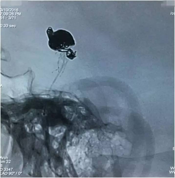 基底动脉顶端动脉瘤加左侧小脑上动脉瘤以Y型支架结合弹簧圈栓塞