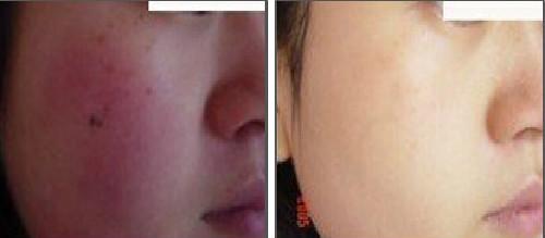 怎么去脸部*血丝红**-敏感肌修复瑞玲老师8000肤诊案例连载009