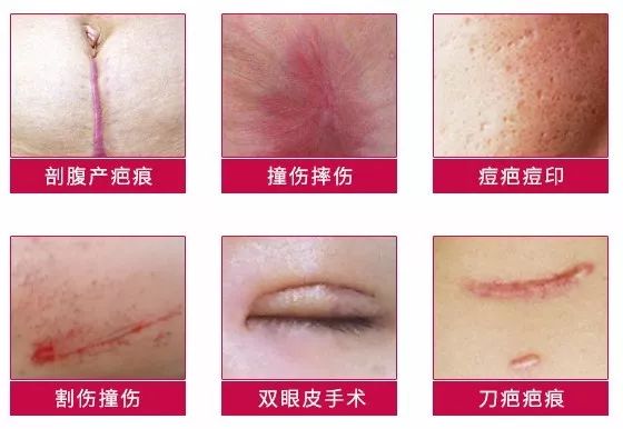 理肤泉和雅漾修复泛红哪个好,雅漾和理肤泉哪个更适合修复皮肤