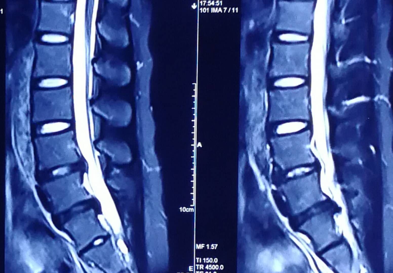 美女们的腰椎间盘突出这么多?
