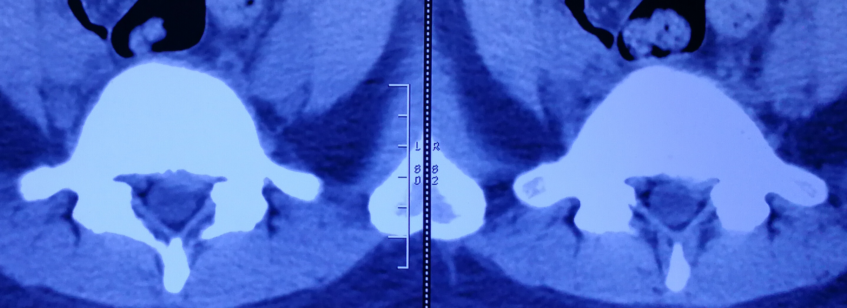 美女们，我该如何去拯救你们椎间盘突出的腰？