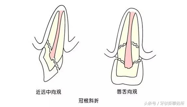 牙齿敏感抗敏牙膏有效吗,牙齿冷热酸甜都敏感用哪种牙膏