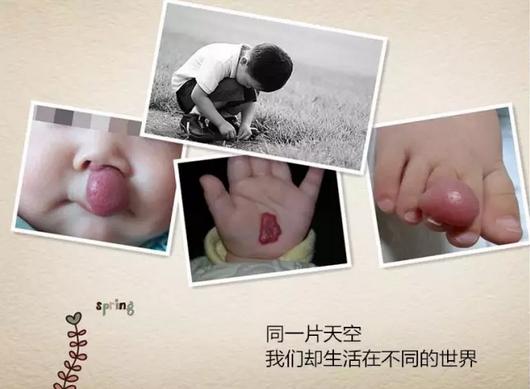 胎记治疗无效果,胎记治疗切勿操之过急