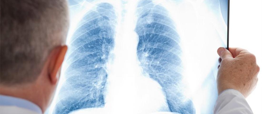 奥希替尼耐药后的第四代靶向药,奥希替尼耐药后有什么新药