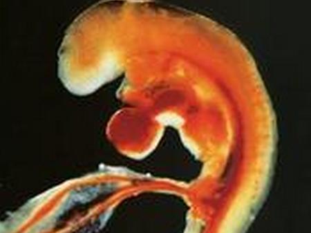 保胎到胎儿畸形30周引产自述,孕妇怀孕34周坚持引产后续