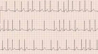 让心率慢下来偏方,心跳缓慢且房颤用什么药为宜