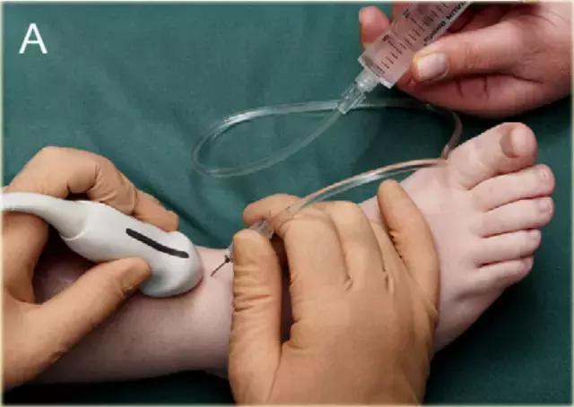 超声引导穿刺和介入穿刺的优缺点,关节超声引导