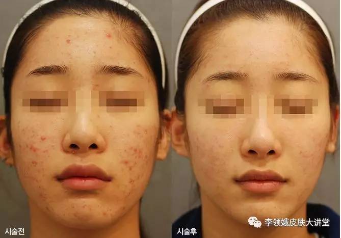 光动力治疗后的皮肤变化过程,光动力疗法和光动力治疗有啥区别