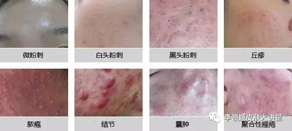 光动力治疗后的皮肤变化过程,光动力疗法和光动力治疗有啥区别