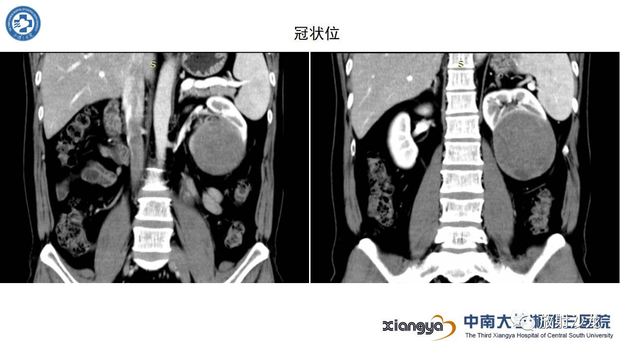左腰侧边撞伤里面隐隐作痛,左腰被撞现在肚子痛