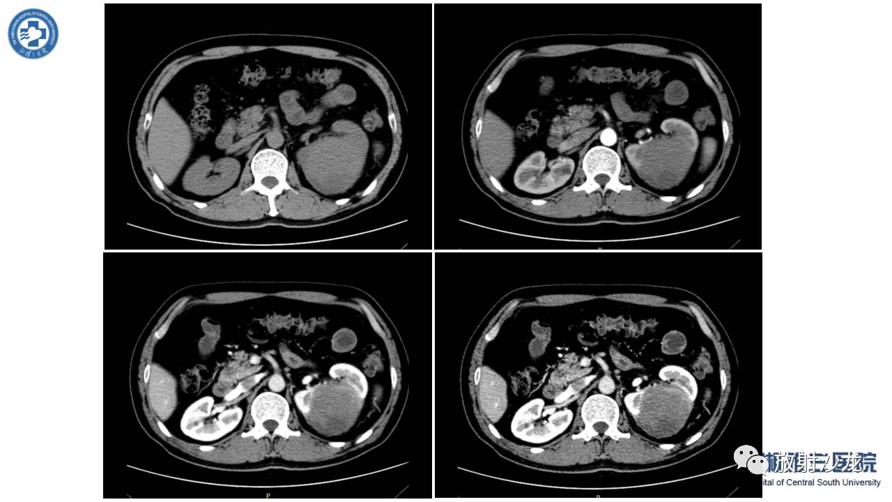 左腰侧边撞伤里面隐隐作痛,左腰被撞现在肚子痛
