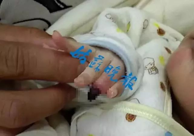 婴儿面临截肢,血泪的教训家长必知