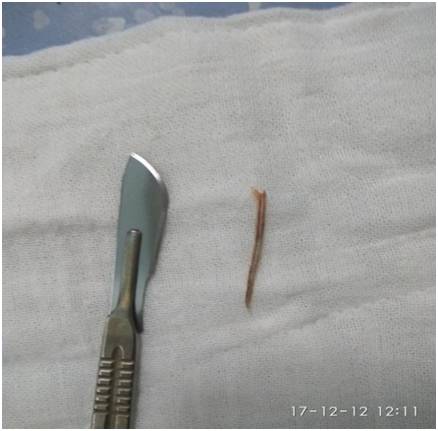 胃里有个大肿块是怎么回事,胃突然有个硬包怎么回事