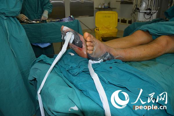 创伤治疗有了新方法你知道什么是VSD吗?