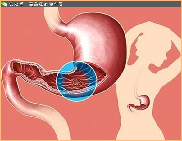 慢性胃炎药膳大全,慢性胃炎食疗建议