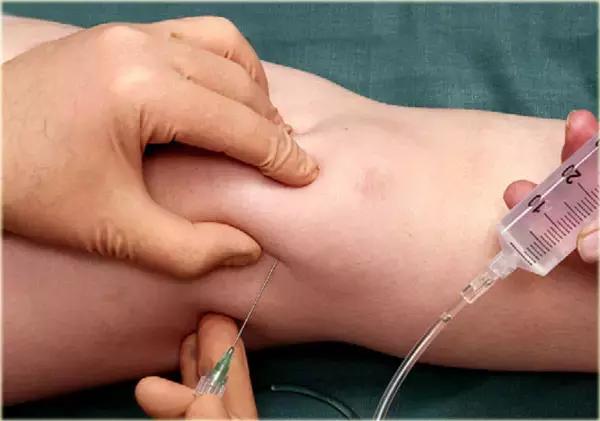 超声引导穿刺和介入穿刺的优缺点,关节超声引导