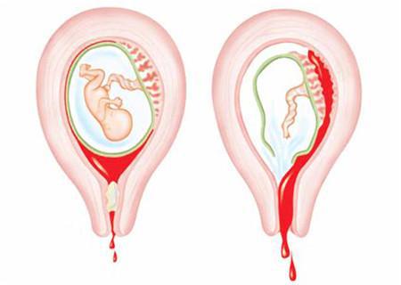 怀孕女护士被踢至先兆流产｜意外发生先兆流产该如何保胎？