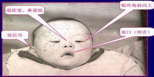 孕期检查什么项目是排查胎儿畸形,孕中期唐筛和大排畸检查重要吗