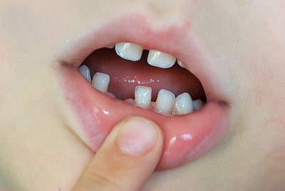 宝宝烂嘴角是什么原因该怎么办,宝宝烂嘴角怎么办别急试试这几招