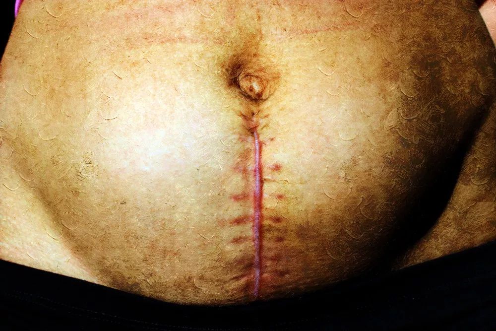 哪些女星是剖腹产,哪些女星是剖腹产的